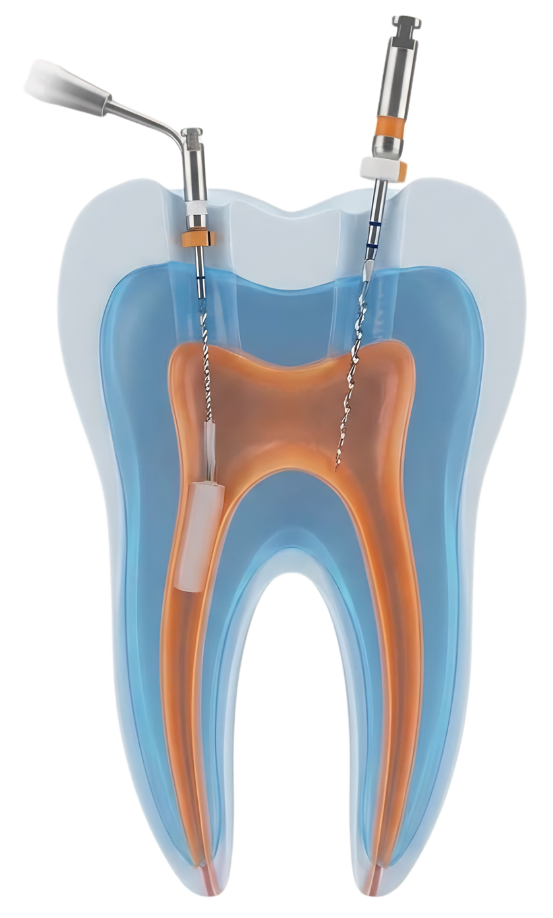 Root Canal