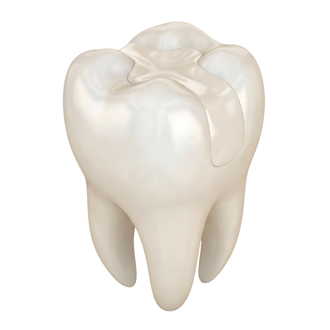 Tooth-Colored Composite Fillings