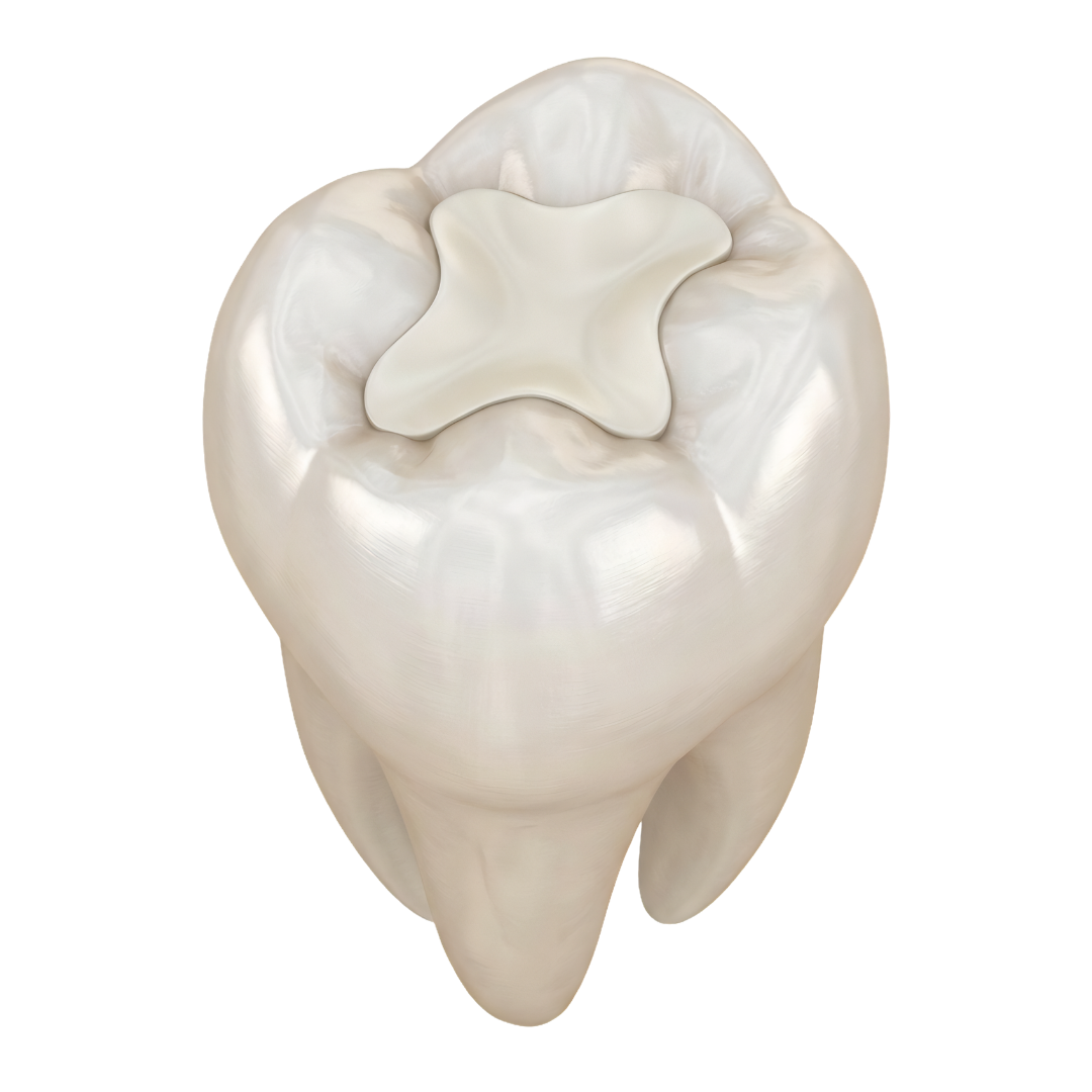Glass Ionomer Fillings