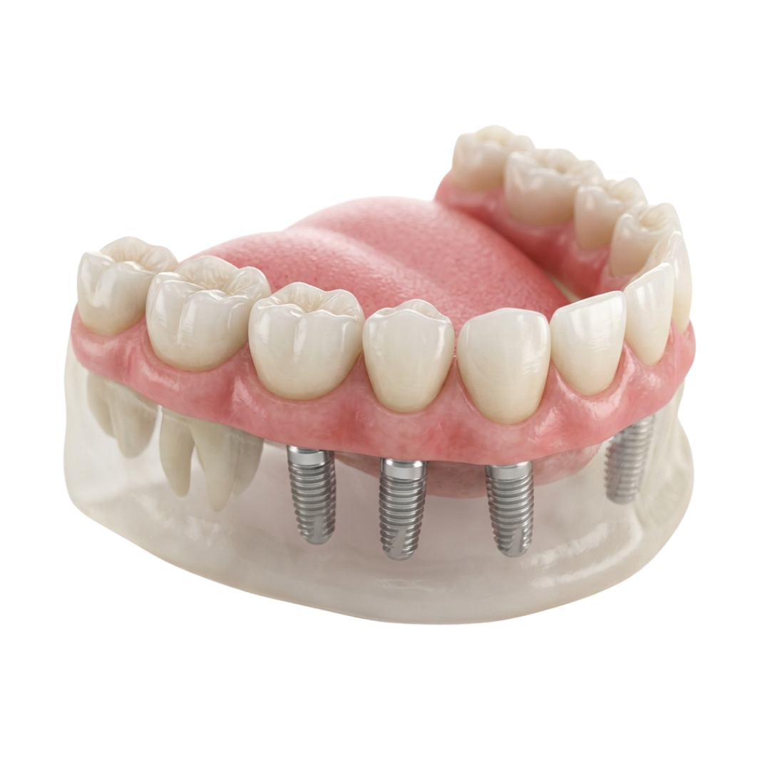 Implants in 72 Hours