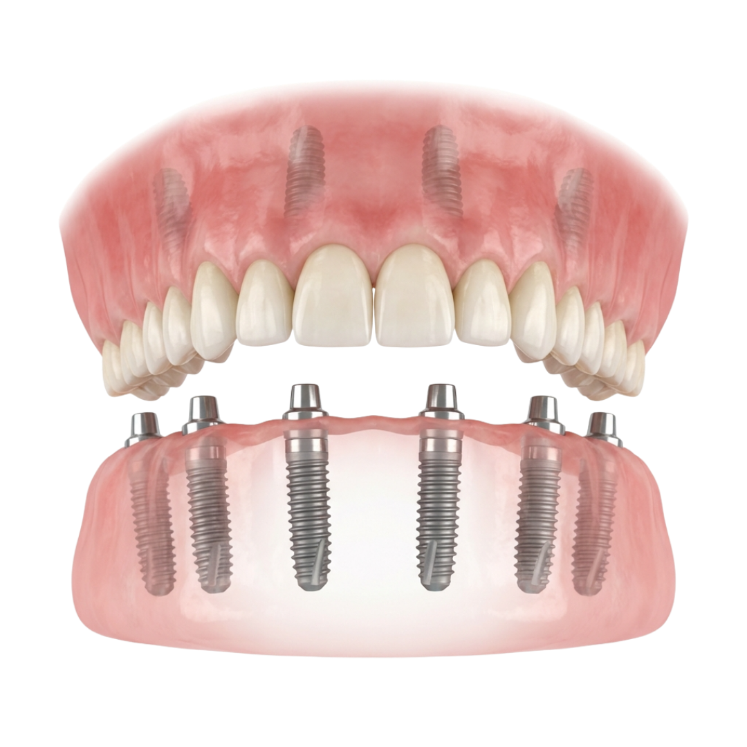 Full Mouth Implants